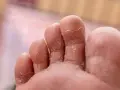 Close-up of toes with peeling skin, a common symptom of athlete's foot. Many wonder if Epsom salt is good for athlete's foot.