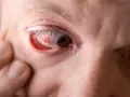 Nagłe objawy udaru oka, które mogą zagrażać twojemu wzrokowi