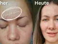 Vorher: Haut mit Rötungen und Pickelchen, gekennzeichnet als "Fungal Akne". Heute: Klare, strahlende Haut.