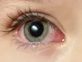 Occhio con congiuntivite, il cui significato è infiammazione. La sclera è arrossata e irritata.