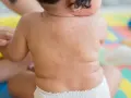 Roter Ausschlag auf dem Rücken eines Babys, möglicherweise nach drei Tagen Fieber.