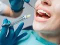 Czy na NFZ przysługuje znieczulenie u dentysty? Sprawdź zasady i warunki