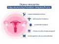 Objawy raka jajnika: częste oddawanie moczu, ból brzucha, wzdęcia, zmiany cyklu, utrata apetytu. Warto dyskutować o tym na forum, by rozpoznać pierwsze objawy.