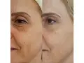 Vorher-nachher-Vergleich der Haut einer Frau: Deutliche Reduzierung von Falten und Pigmentflecken nach Anwendung von Retinol.