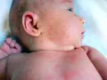Skaza białkowa czy potówki u niemowlaka? Rozpoznaj objawy!