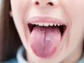 Usta z wysuniętym językiem. Szukasz sposobów, jak złagodzić pieczenie języka domowe sposoby?
