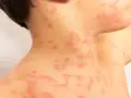 Primer plano de sarpullidos en la piel de un niño, con manchas rojas y elevadas en el cuello y el hombro.