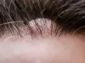 Primo piano della pelle con capelli scuri e una protuberanza sulla fronte, forse un brufolo o un piccolo neo.