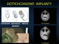 Nowoczesne implanty ślimakowe, w tym niewidoczny implant, poprawiają słuch.