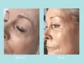 Before and after images show a woman's face. The "before" side displays dehydrated, dull skin with visible wrinkles. The "after" side reveals plump, hydrated, and radiant skin.