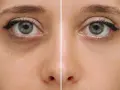 Comparación de ojos: antes con ojeras vasculares oscuras y después con piel más clara y uniforme.