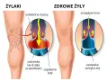 Ilustracja pokazuje nogę z żylakami i zdrową nogę. Flebolog wyjaśnia, że przy żylakach zastawki nie działają, powodując zapalenie.