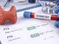 Model tarczycy, probówka z krwią "THYROID TEST" i wyniki badań FT3, FT4.
