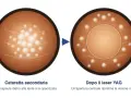 Prima e dopo il laser YAG: la capsula opacizzata della cataratta secondaria viene trattata con un barrage laser retina per ripristinare la visione nitida.