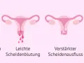 Brustveränderungen, leichte Blutungen, verstärkter Ausfluss und Müdigkeit können Anzeichen sein, dass die periode bleibt aus.