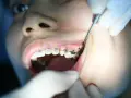 Aparat samoligaturujący wady zgryzu. Dentyści korygują zęby.