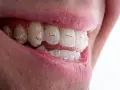 Zbliżenie na uśmiech z niewidocznymi nakładkami Invisalign. Poznaj atrakcyjną **invisalign aparat cena** i ciesz się prostymi zębami.