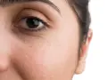 Nahaufnahme eines Auges mit kleinen weißen Milien unter dem Auge, die entfernt werden sollen.