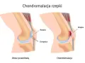 Porównanie zdrowego kolana z zaawansowaną chondromalacją 4 stopnia, gdzie chrząstka rzepki jest mocno uszkodzona.