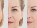 Comparaison avant/après : peau marquée par le temps, puis lissée grâce à l'acide hyaluronique sur le front et le visage.