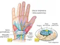 Anatomia dłoni ilustrująca ucisk na nerw pośrodkowy w kanale nadgarstka, powodujący drętwienie palców.