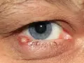 Gerötetes Augenlid mit gelblichem Gerstenkorn. Die Haut um die Augen brennt und juckt.