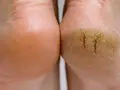 Gros plan sur deux talons, l'un sain et l'autre très sec, craquelé, montrant la différence de texture.
