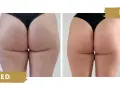 Endermologia: Jak działa, efekty, cena i wskazania poznaj wszystko
