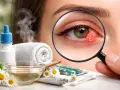 Occhio arrossato e infiammato, con un piccolo brufolo. Rimedi naturali e farmaci per il problema "olio nell'occhio cosa fare".