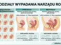 Ilustracja pokazuje wypadanie macicy i innych narządów miednicy mniejszej, z podziałem na stopnie zaawansowania i możliwości leczenia, np. pesary.
