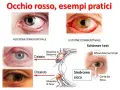 Occhio rosso che lacrima per allergia, ustione, calazio, orzaiolo e sindrome sicca. Test di Schirmer con carta da filtro.