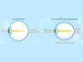 Diagramma mostra come vede un astigmatico: la luce si focalizza in più punti invece che in uno solo, creando una visione sfocata.