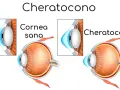 Confronto tra cornea sana e cheratocono: la vista di un occhio sano e uno affetto da cheratocono, che mostra la deformazione della cornea.
