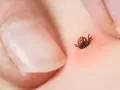 Kleszcz wbity w skórę, zaczerwienienie wokół. Uważaj na kleszcze u dziecka podczas spacerów po lesie.