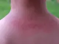 Sarpullido en el cuello, con piel enrojecida y pequeños bultos.