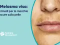 Primo piano del viso con macchie scure sopra il labbro, tipiche del melasma baffetti. Rimedi per le macchie scure sulla pelle.