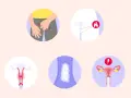 Illustrationen zeigen Juckreiz im Intimbereich, Entzündungssymptome, Ausfluss und Schmerzen. So sieht scheidenpilz aus.