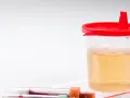 Pojemnik z żółtym płynem i próbówki z krwią. Wyniki badań wskazują na erytrocyty w moczu.