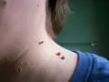 Piel con varias verrugas marrones y rojizas en el cuello, algunas agrupadas, sugiriendo la necesidad de quemar verrugas.