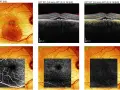 Immagini OCT e IR di un occhio con segni di retinopatia da stress, mostrando alterazioni vascolari e strutturali.