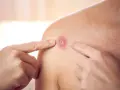 Jak wyciskać pryszcze bez ryzyka blizn i infekcji skóry
