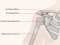Anatomie der Schulter: Schlüsselbein, Schulterdach, Schulterhauptgelenk und Oberarmknochen. Die Heilung des Schulter-Arm-Syndroms kann variieren.