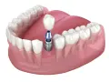 Brak piątki? Ile kosztuje implant, most, proteza? Porównanie cen