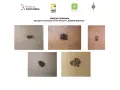 Zbliżenia różnych znamion i czerniaków na skórze.