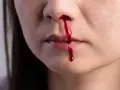 Krew cieknie z nosa, tworząc krople. To nie jest exacyl.