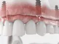 Model szczęki z implantami. Podniesienie dna zatoki szczękowej cena zabiegu jest kluczowa dla stabilności implantów.