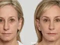 Przed i po zabiegu biostymulatorami: wygładzona skóra, zredukowane zmarszczki wokół oczu i ust, odmłodzony wygląd.
