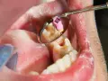 Zgorzel zęba to martwica miazgi. Widoczny ząb w lustrze dentystycznym, z narzędziem w kanale korzeniowym.
