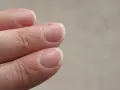 Zbliżenie na palce, widać suche skórki przy paznokciach, które wymagają nawilżenia.