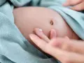Delikatna pielęgnacja brzuszka niemowlaka. Kropelka kremu na palcu, gotowa do naniesienia na pępek, gdzie może występować przepuklina pępkowa.